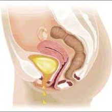 Urine Leakage treatment in nagpur