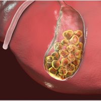 Bladder Stones treatment in nagpur