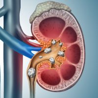 blog-kidneystones