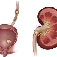Urine Stone treatment in nagpur